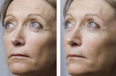 Мезотерапия лица. Фото до и после
