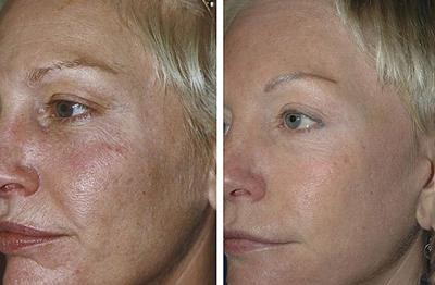 Биоревитализация кожи лица. Фото до и после